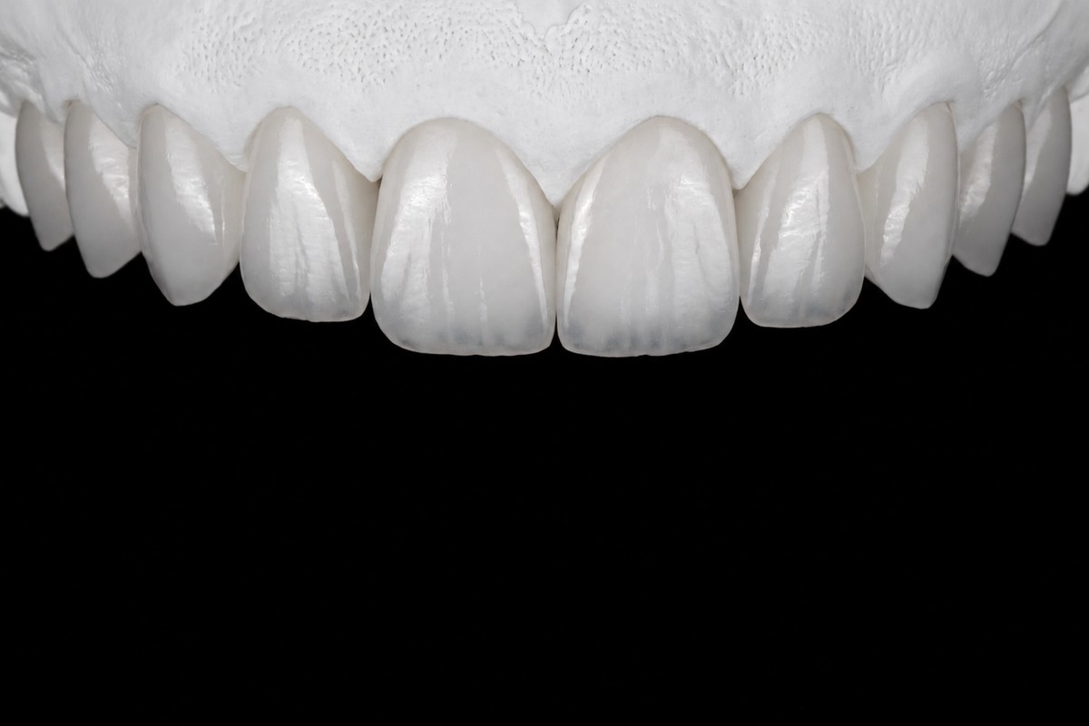 Cosmetic Restorations